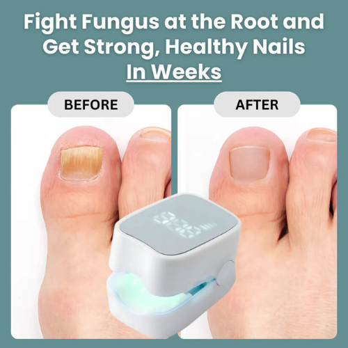 Viorra Pro™ - Nail Fungus Laser Device