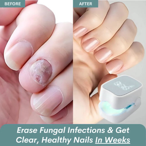 Viorra Pro™ - Nail Fungus Laser Device