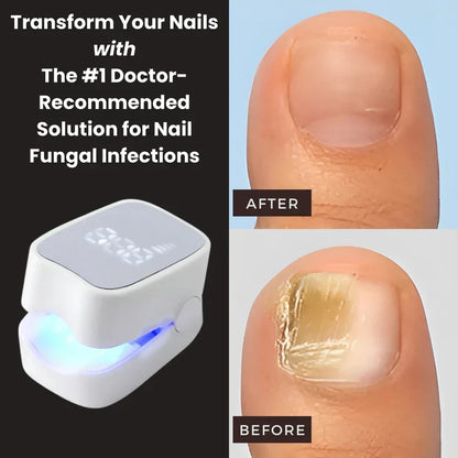 Viorra Pro™ - Nail Fungus Laser Device